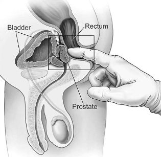 the treatment of prostatitis at home massage
