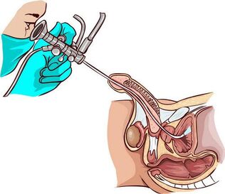 Ureteroscopic procedure
